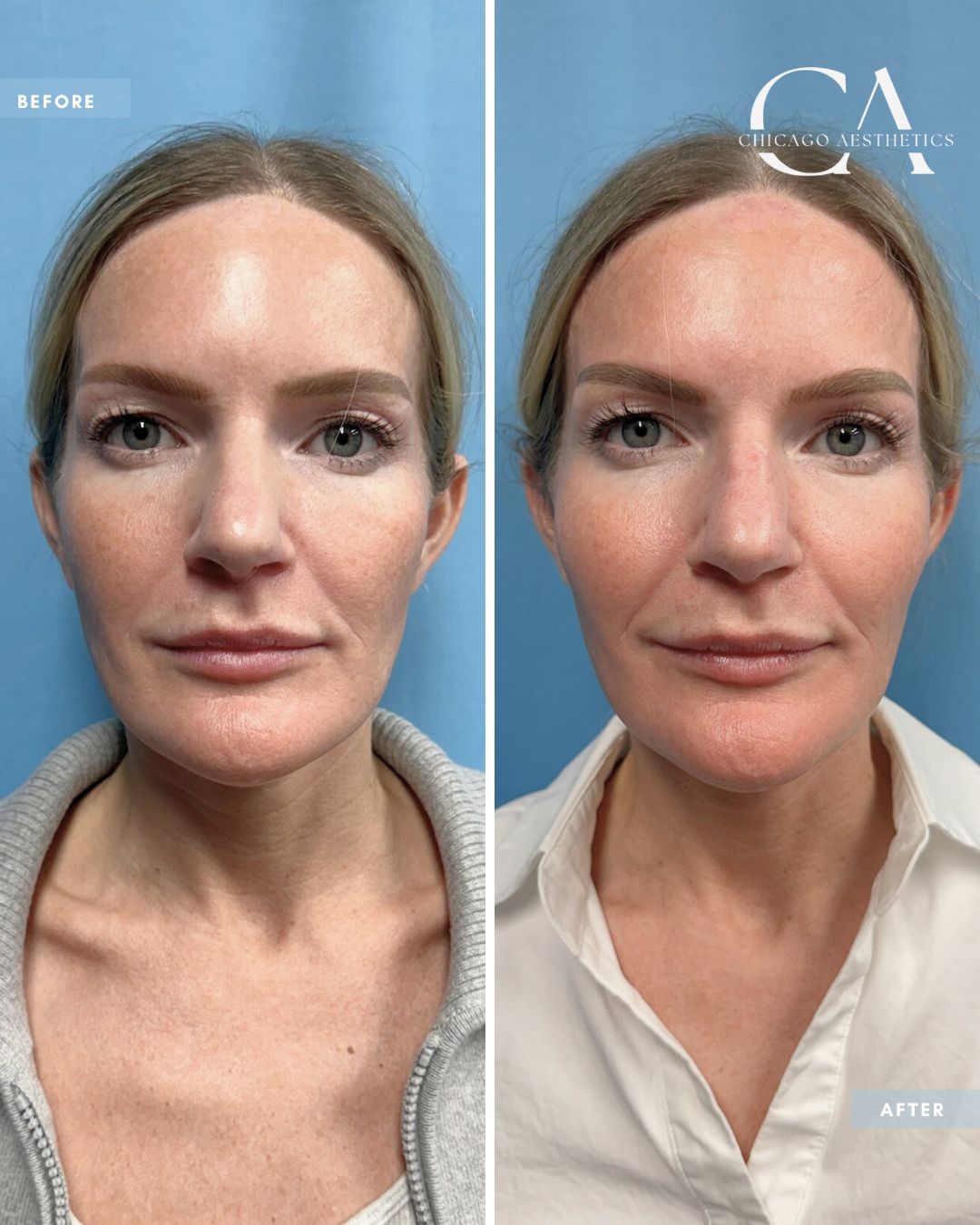 #166 - Radiesse Temples and Mid-Face Tom Recko Chicago