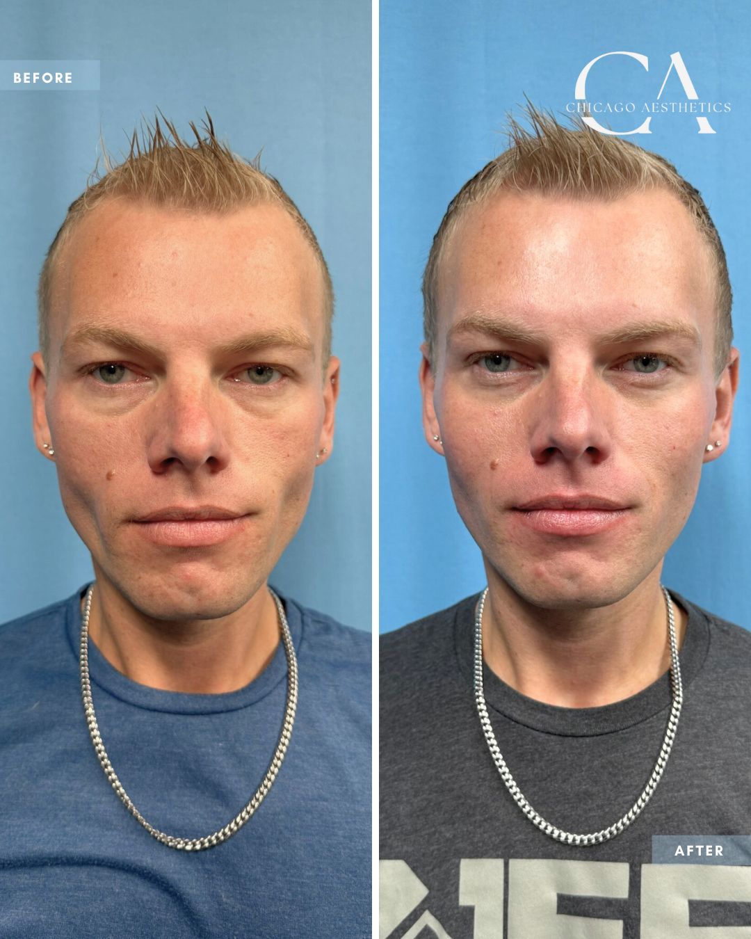 #165 - Radiesse Mid-Face Tom Recko Chicago