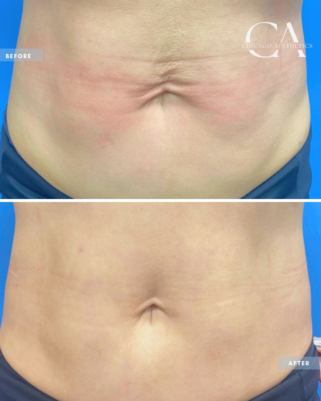 1898047 Sofwave Abdomen Lift Alison Falada Chicago