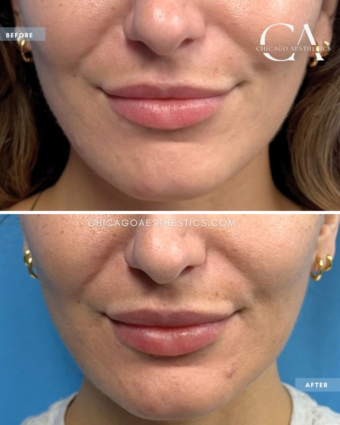 #323 Lip Filler Thomas Recko Chicago