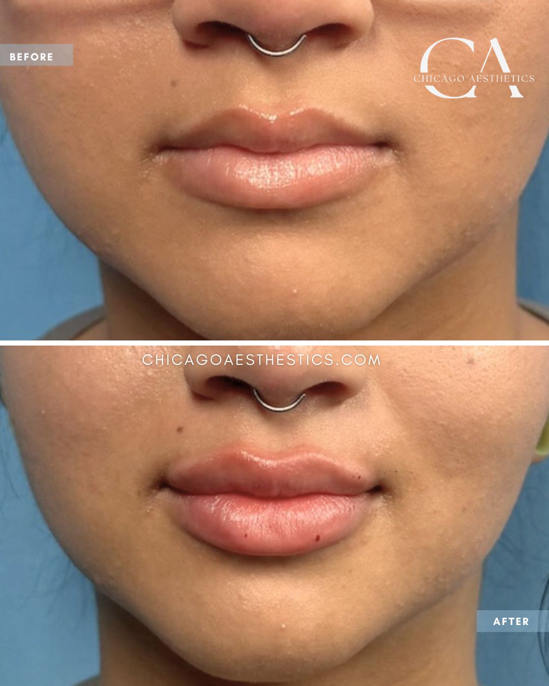 #322 Lip Filler Thomas Recko Chicago