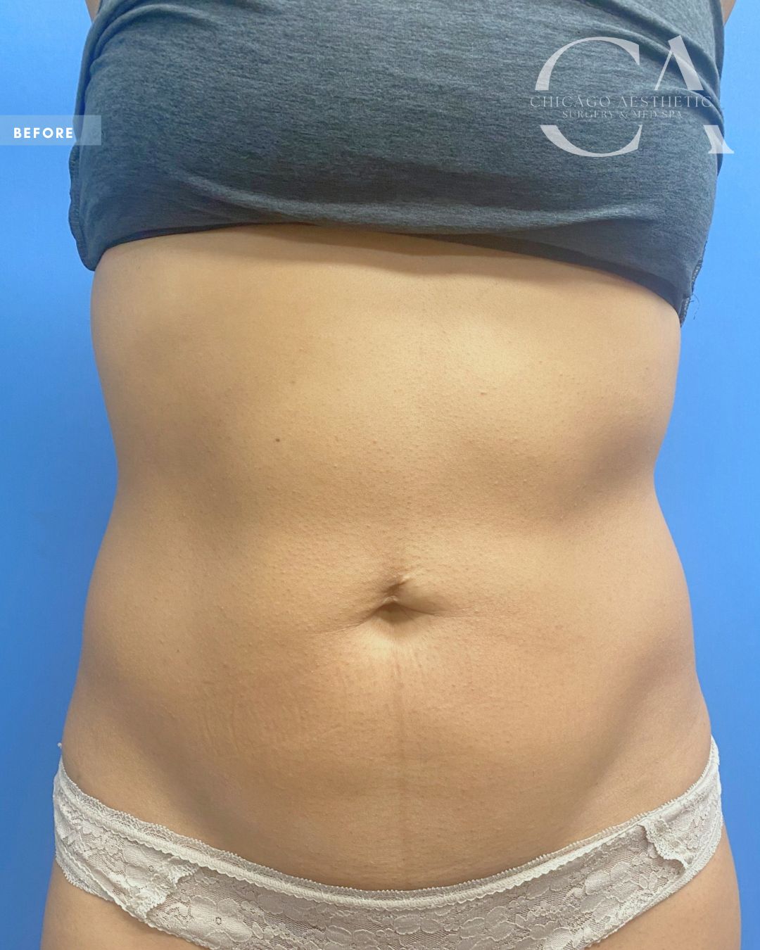 1682152 Morpheus8 Body Abdomen Lift Alison Falada Chicago 3tx (3)