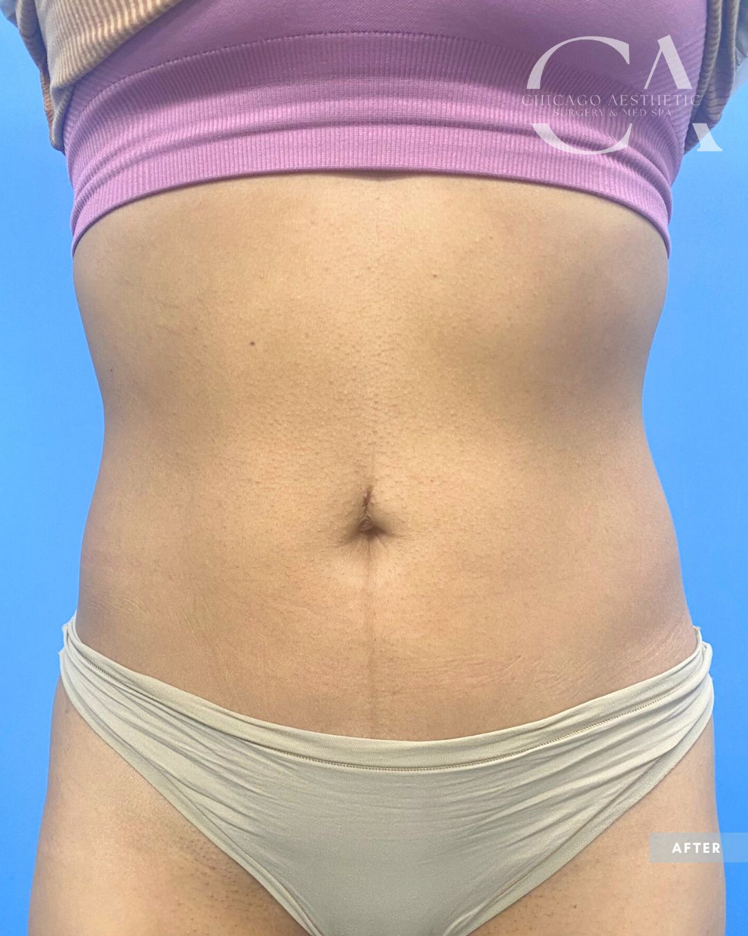 1682152 Morpheus8 Body Abdomen Lift Alison Falada Chicago 3tx (3)